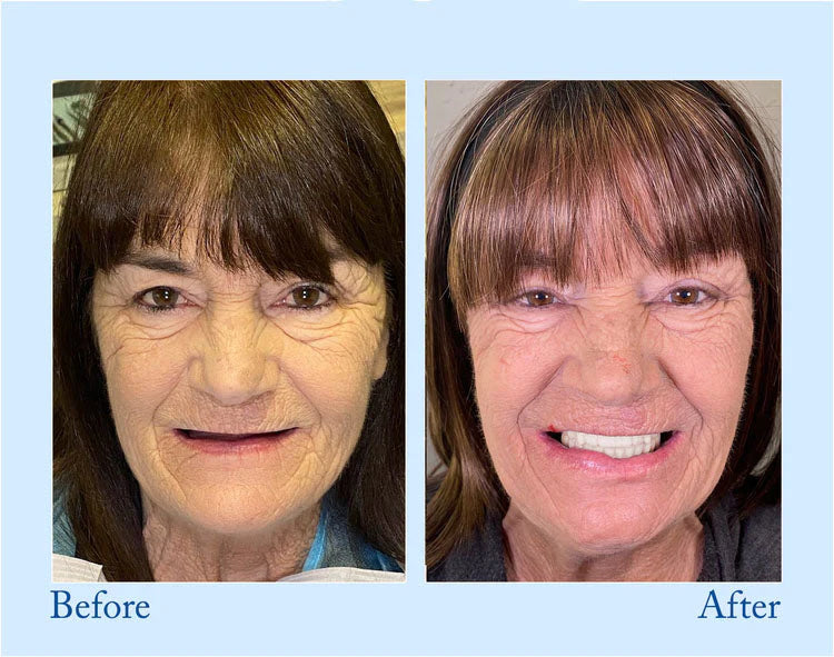 🦷Advanced Customized Full Denture Set🦷  (🔥10.000+ Sold In Last 30 Day)